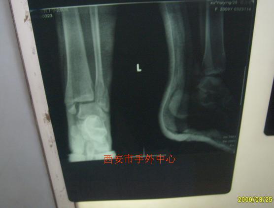 一例三踝骨折 - 经典病例 - 中华手外科网