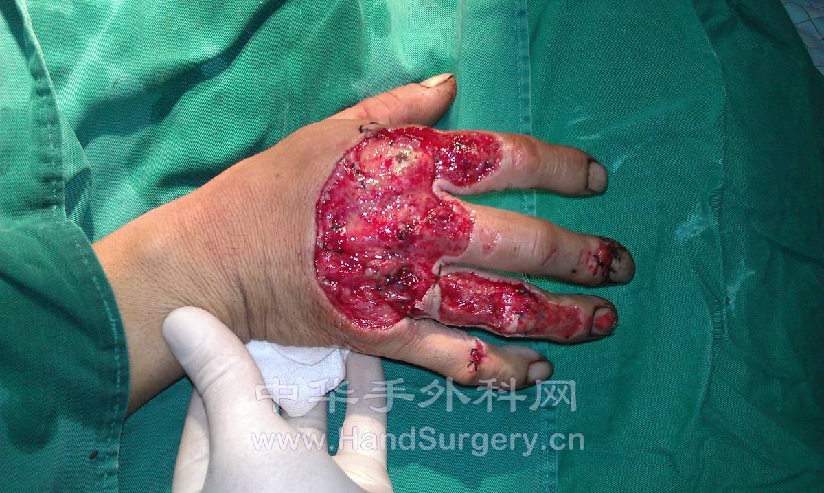 一例右手背皮肤撕脱伤VSD修复 - 经典病例 中