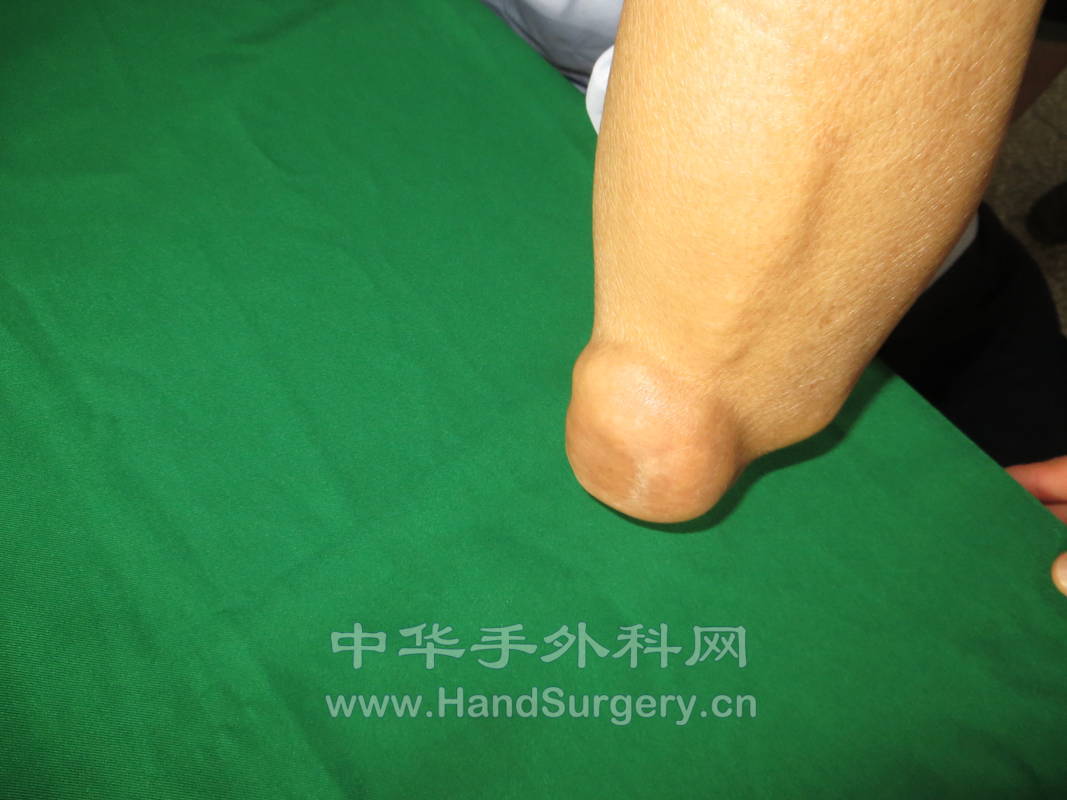 难得一见的手部痛风石 - 经典病例 - 中华手外科