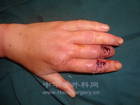 中环指末节软组织缺损双邻指皮瓣修复 ...