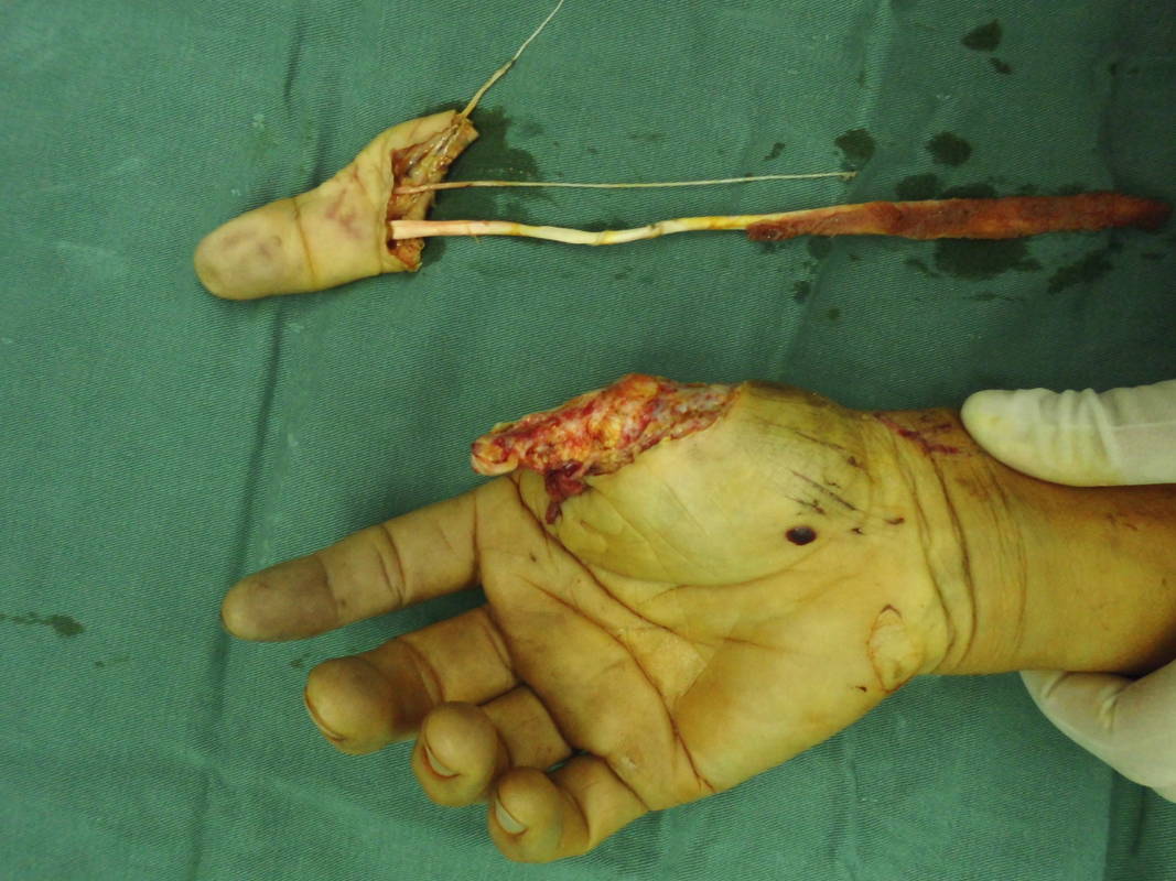 拇指指间关节处旋转撕脱离断再植 - 经典病例 