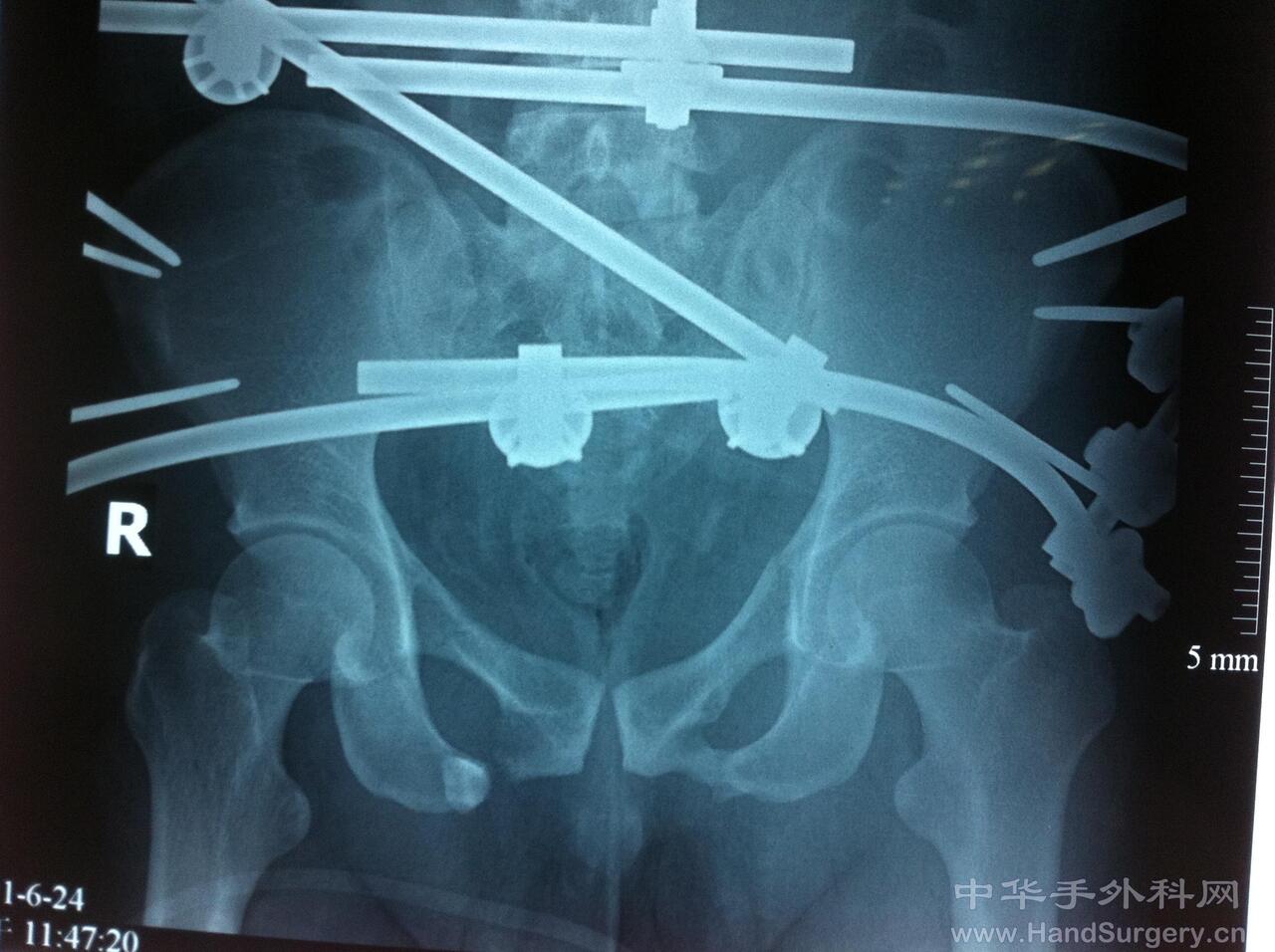 骨盆骨折急诊手术外支架复位固定 - 经典病例 