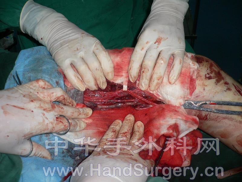 栓塞的股动脉 - 经典病例 - 中华手外科网