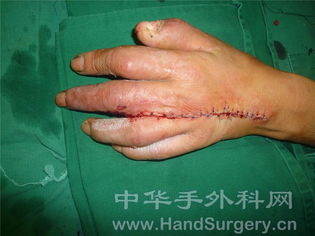 第3掌背动脉皮瓣 - 经典病例 - 中华手外科网