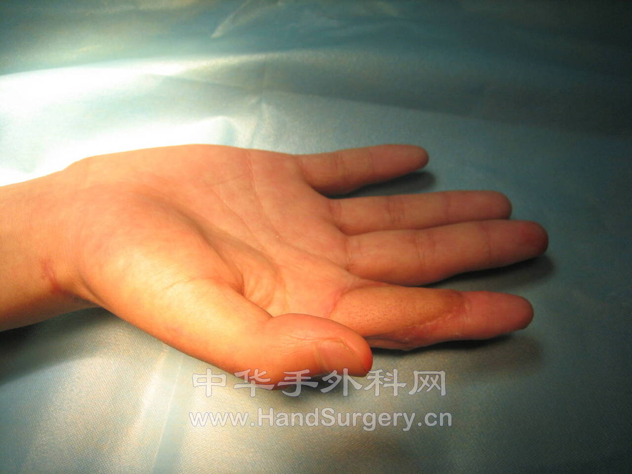 第一掌背动脉皮瓣 - 经典病例 - 中华手外科网