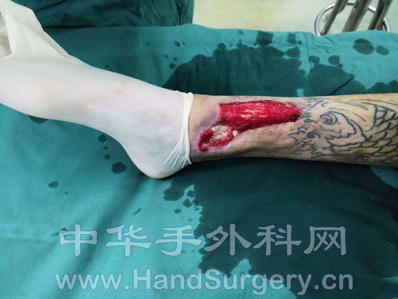 右-> 帖子模式 发布时间: 2018-10-20 11:14 正文摘要:  内踝骨折术后