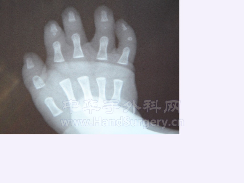 右手X片