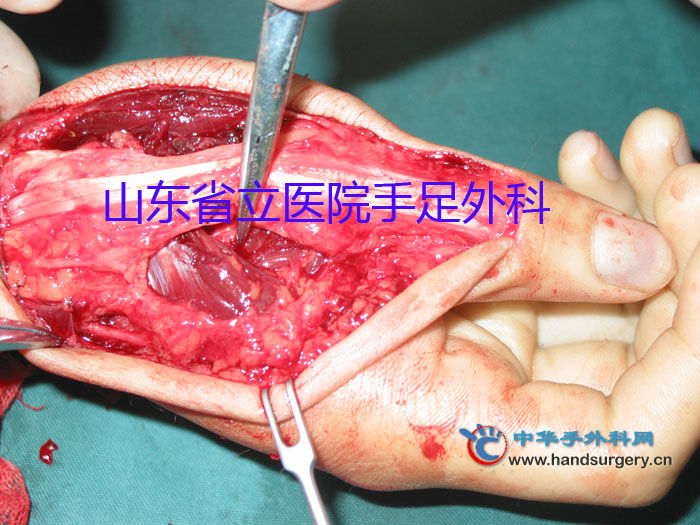 鱼际部血管瘤 - 经典病例 - 中华手外科网