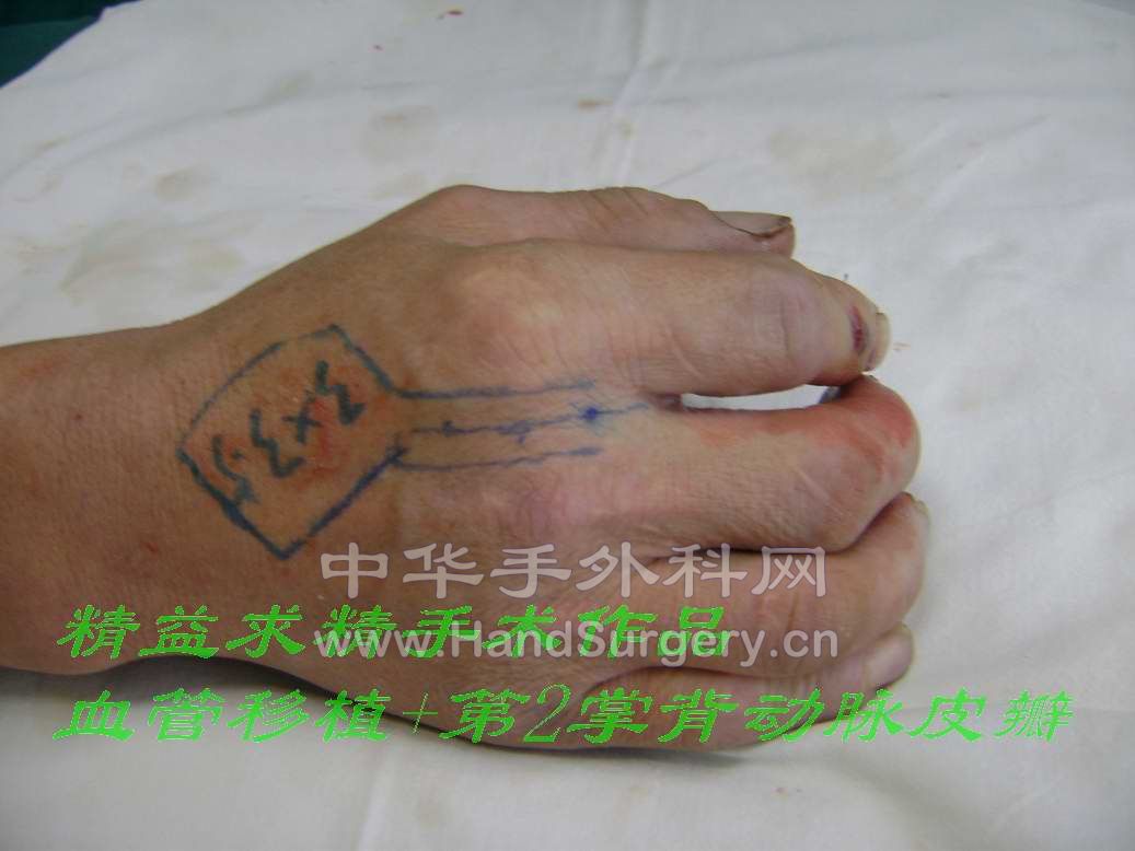 静脉移植+第2掌背动脉皮瓣术 - 经典病例 - 中华