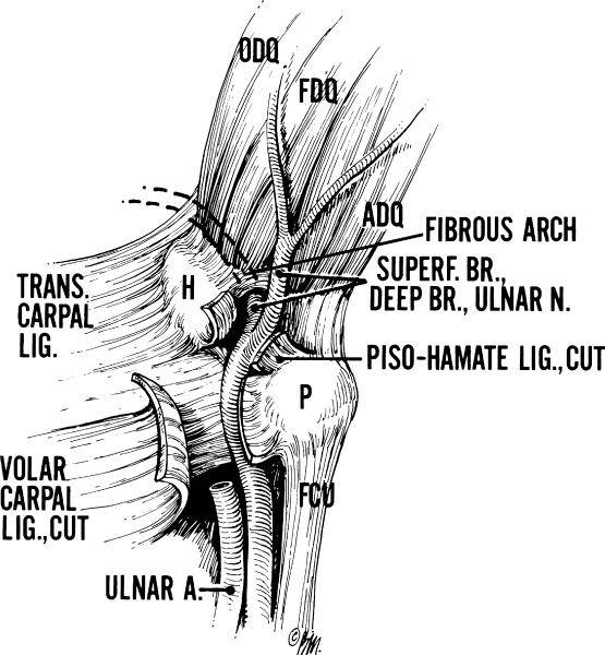 The ulnar nerve courses through Guyon's canal between the volar carpal liga.png