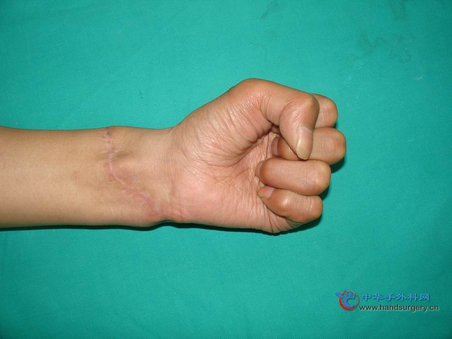 术后握拳、屈指，注意拇指的位置，说明虎口无挛缩，防治的方法是在再植后，第一、二掌骨间用钢针固定撑开，1个月后拔 ...