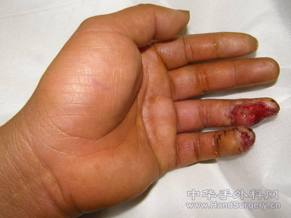 左手环指末节指腹偏尺侧组织缺损