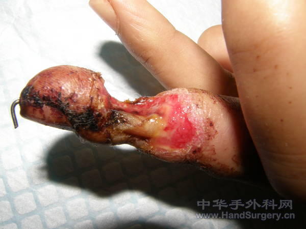 右手中指偏尺侧组织缺损，指骨外露