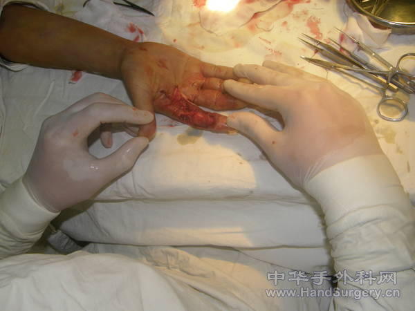 右手食指掌侧组织缺损情况