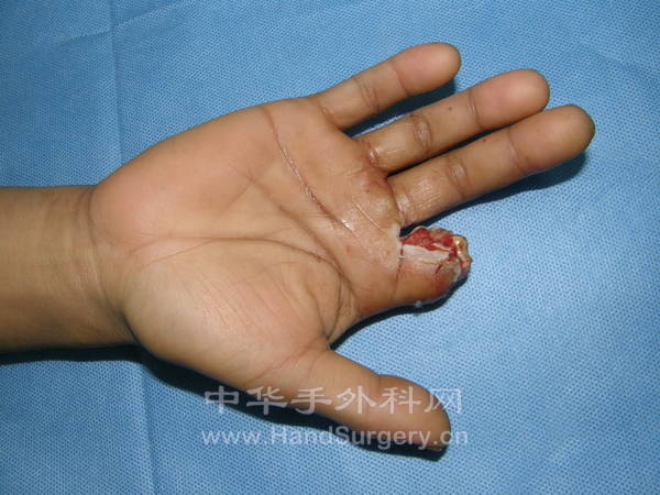 右手食指近节以远损伤情况
