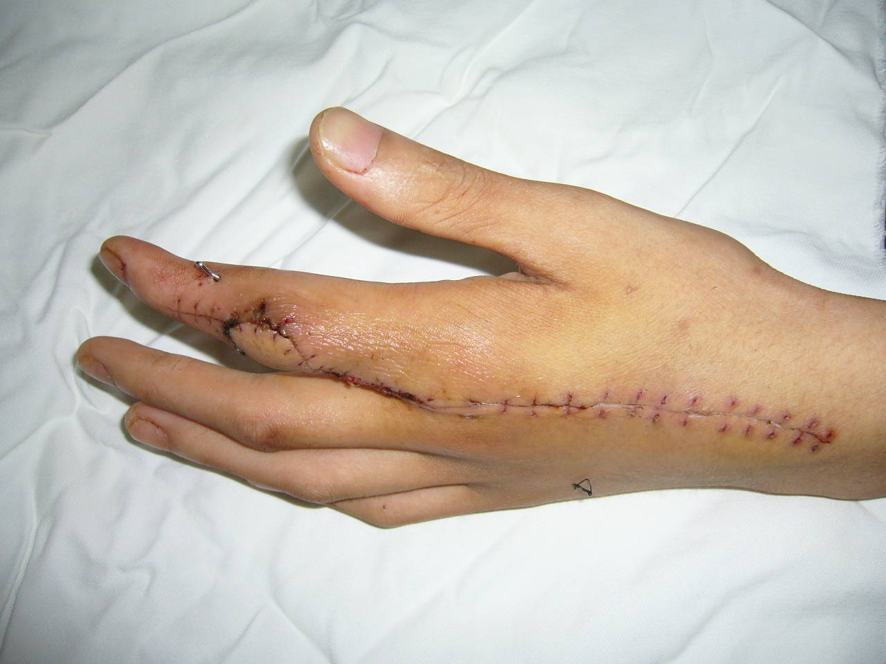 手指骨膜损伤图片图片