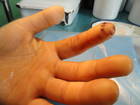 左手食指末节不全离断伤