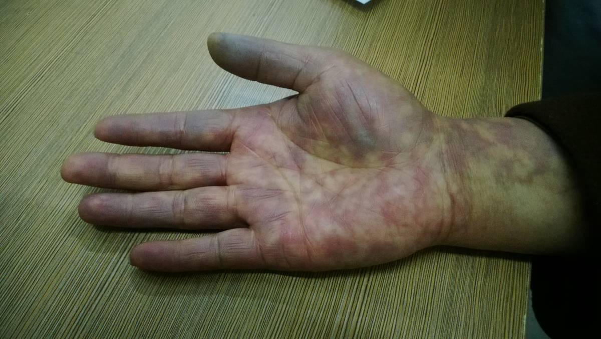 手指筋膜炎的症状图片图片