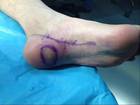 足底胼胝体，患者走路疼痛明显，要求切除，扩大切除后，行足底内侧皮瓣转移修复术 ...
