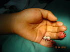 小指指动脉逆行岛状皮瓣修复远端缺损 ... ... ... ...