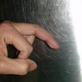 我的相册：足趾趾间关节移植再造左中指近指间关节术 ...
