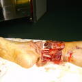 踝上肢体离断再植+股前外侧皮瓣修复术 ...