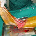 游离串联股前外皮瓣修复小腿大面积缺损 ...