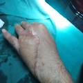 小指毁损性离断尺动脉腕上皮支皮瓣修复 ...