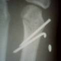 第五掌骨开放性骨折