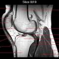 膝关节MRI