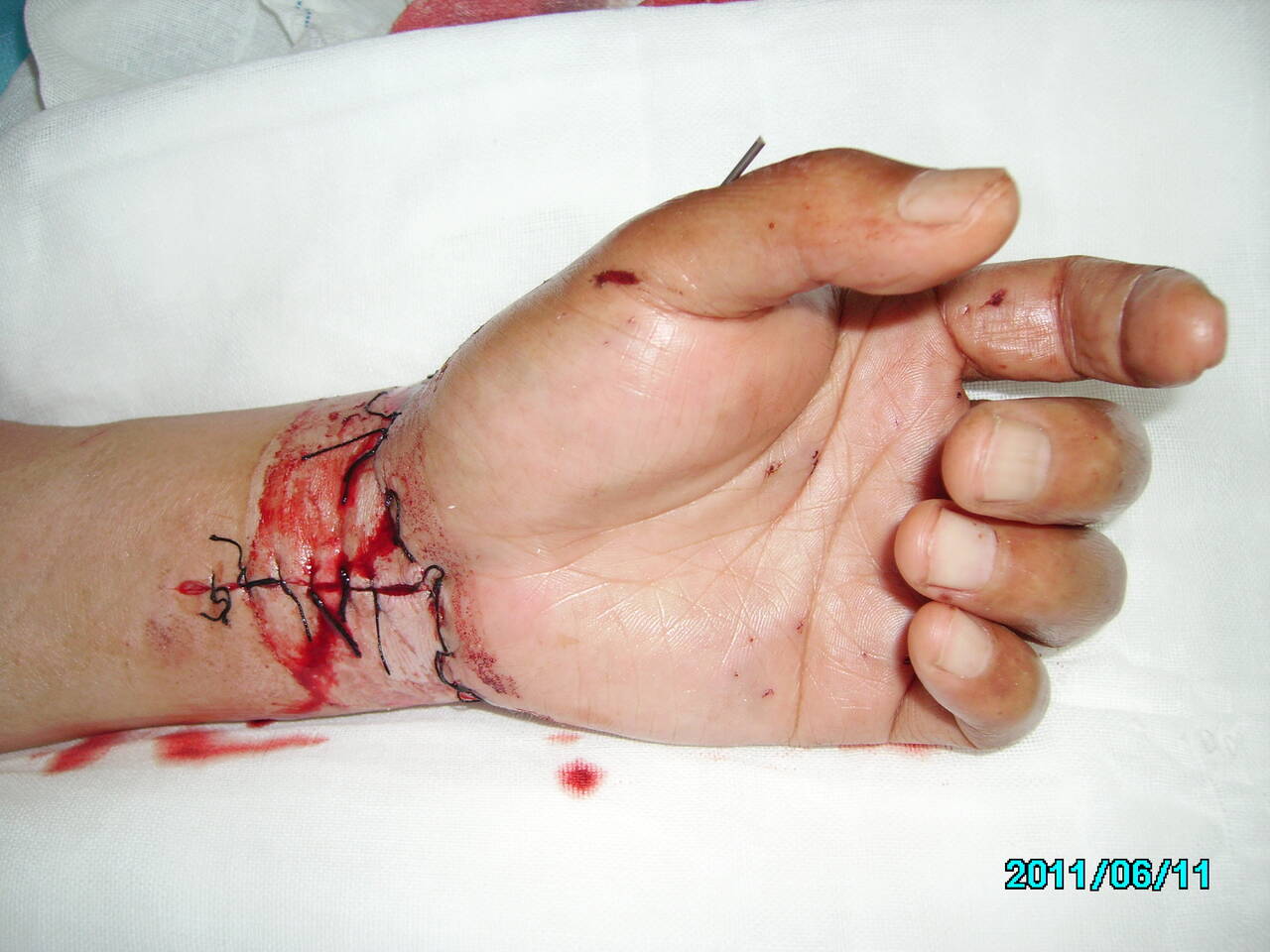 腕部离断伤修复