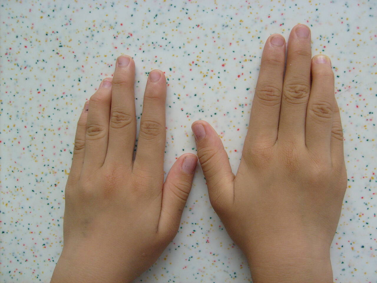 患儿 女 6岁  先天性双手环指锤状指畸形