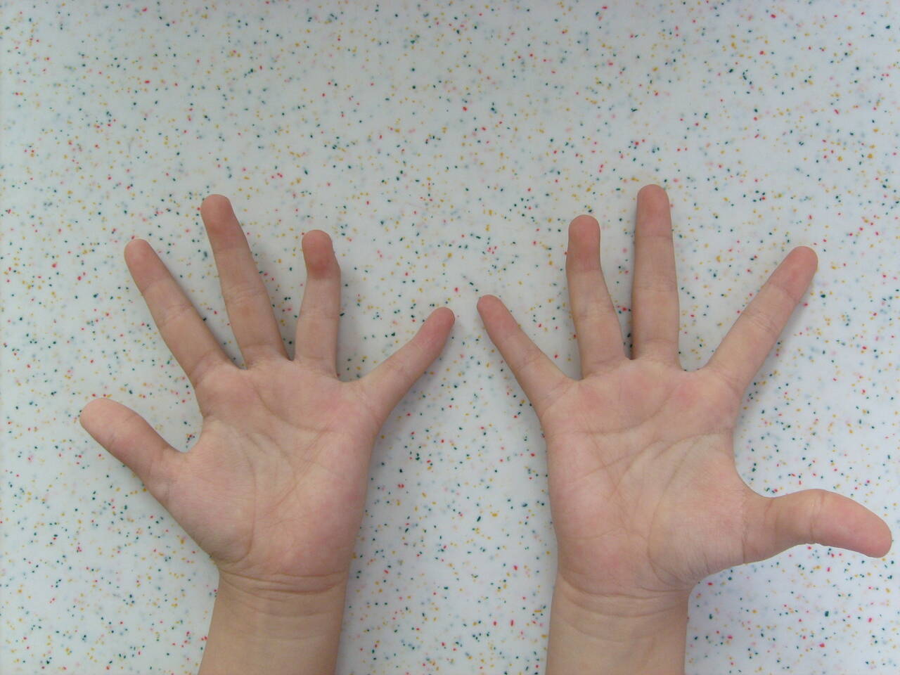 [讨论]先天性锤状指畸形