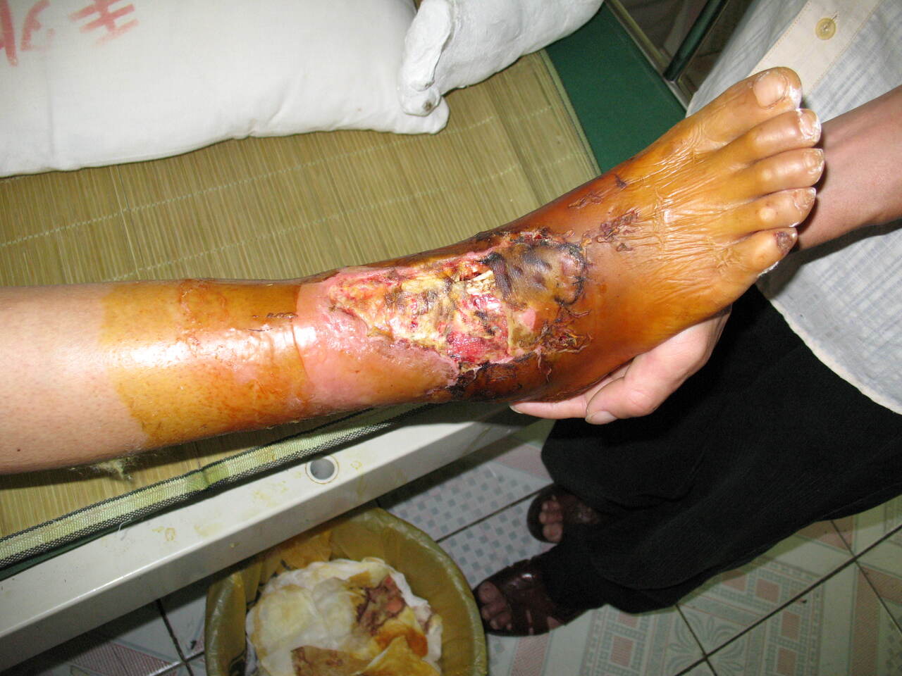 皮肤部分坏死伤口感染见分泌物局部明显肿胀见张力性水疱,患者系高敏