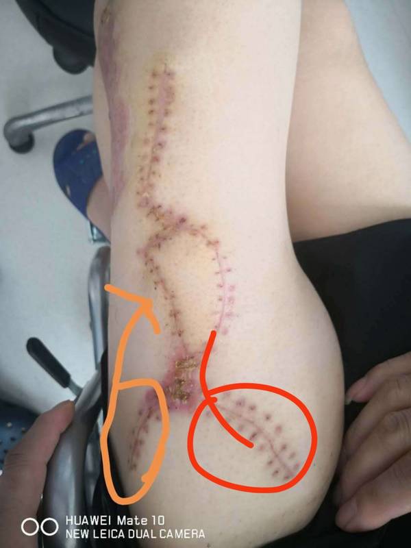 请教股前外侧皮瓣供区处理