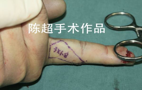 皮瓣设计在示指尺侧，供区隐蔽