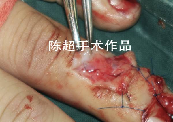 吻合静脉