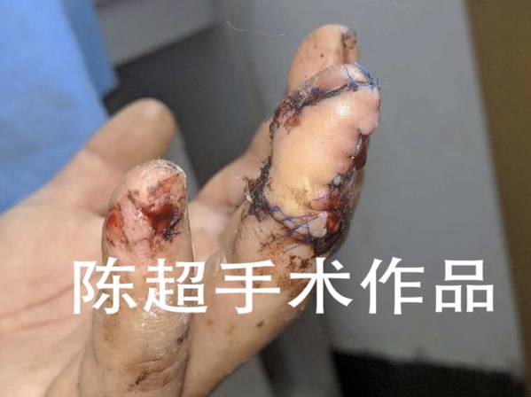 术后一周，皮瓣完全成活