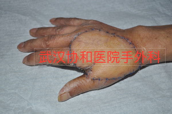 扩大切除病灶区