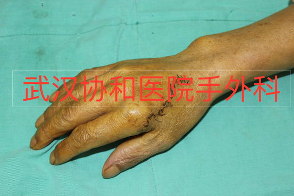 术后两周皮瓣