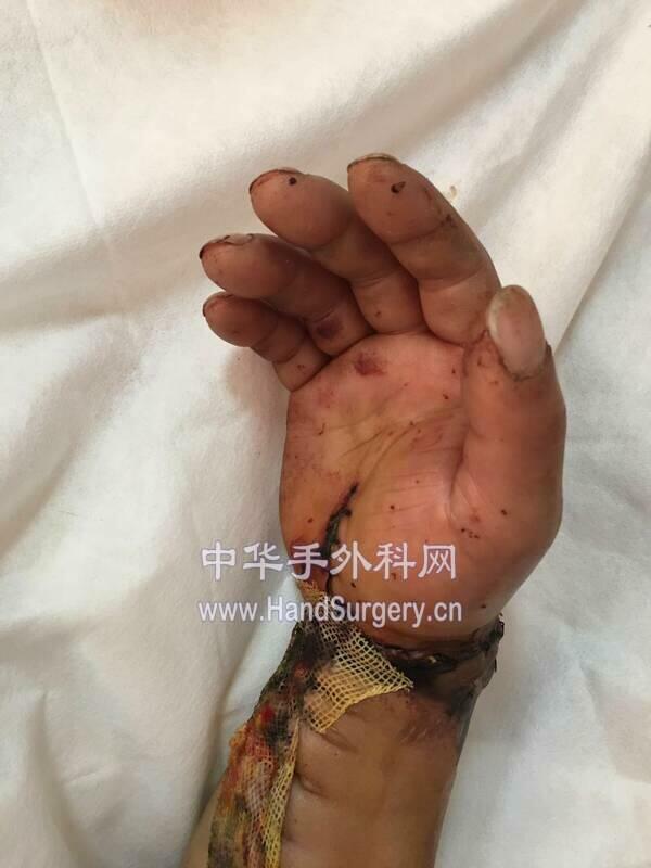 术后12天