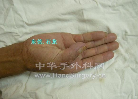 术后2月-2.JPG