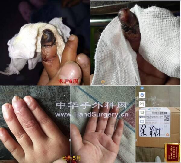 小儿再植二