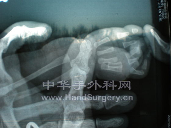 右手X光片2.JPG