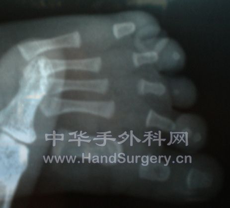 左脚X光片1.JPG