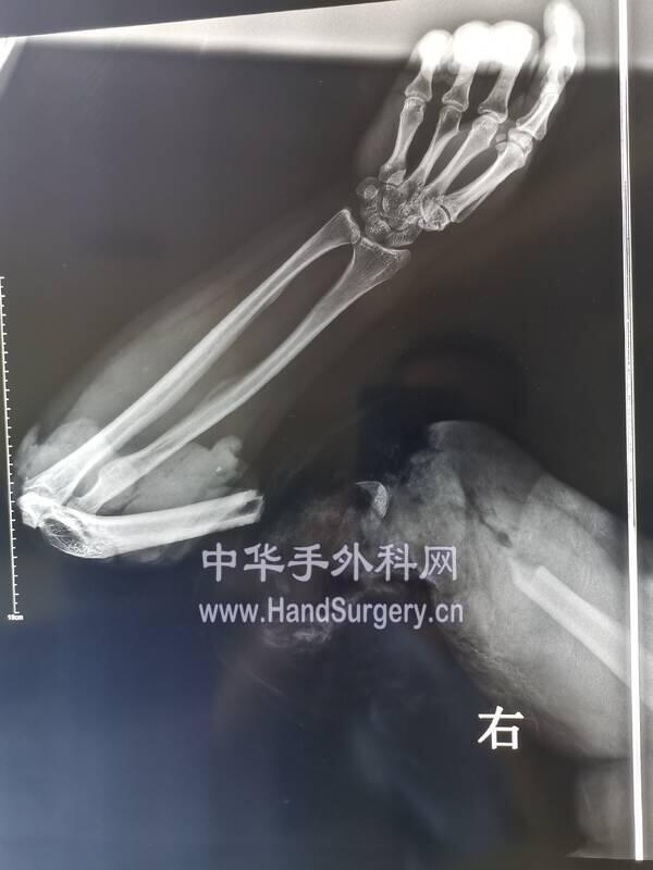 术后外固定支架x线