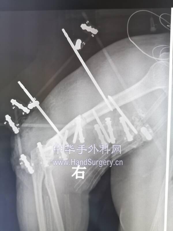 术前x线
