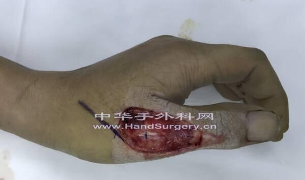患者电锯伤，拇指背软组织缺损，肌腱骨骼外露，给以踇趾腓侧趾背动脉皮瓣修复，术后患者顺利出院 ...