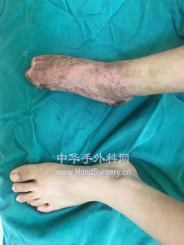 术后2月复查