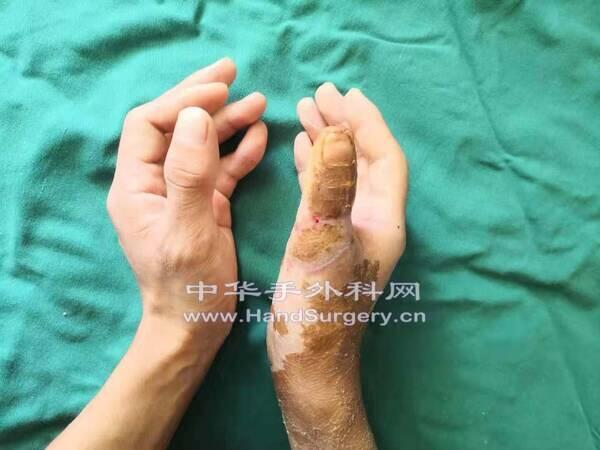 术后一月拆除固定复查